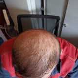 Promed Hair Clinic Kötü Saç Ekimi