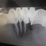 Ondokuz Mayıs Üniversitesi Diş Hekimliği Fakültesi'nde Yapılan Dişlerim İltihaba Sebep Oldu