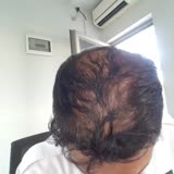 Promed Hair Clinic Saç Ekim Sorunu