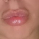 Dr. Nüket Eroğlu Nasolabiafalte Lippen Botox Endopeel Hakkında
