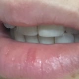 Dentgroup Kırık Ön Dişlerimdeki Yenilenen Dolgular Yemek Yerken Dudağımı Kesiyor
