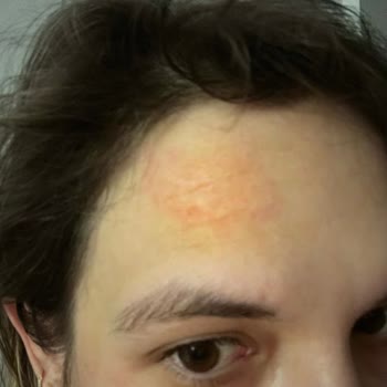 Bepanthol Derma Yüz Kremi Alerjisi