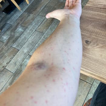 Abdi İbrahim Factive Antibiyotik Yan Etki Alerji Yaptı