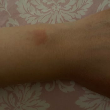 Apple Watch Alerji Yaptı Cildimde İz Kaldı