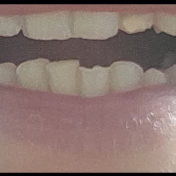 Ülker Çikolatada Çıkan Yabancı Cisim Dişimi Kırdı