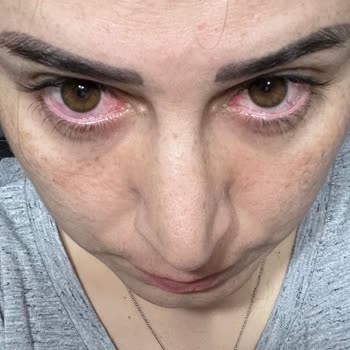 Merve İlk Güzellik Salonu Gözlerim Enfeksiyon Kaptı