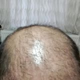 Atlas Hair Center İstanbul Şişli Sıkıntı