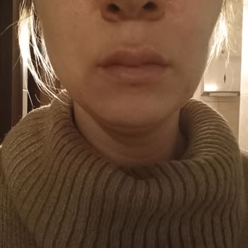 Procsin Asit Dökülmüş Gibi Cildimi Yaktı