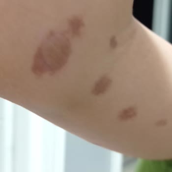 Mine Soydaş Beauty Lazer Kızımın Kollarını Yaktı