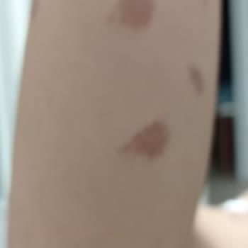 Mine Soydaş Beauty Lazer Kızımın Kollarını Yaktı