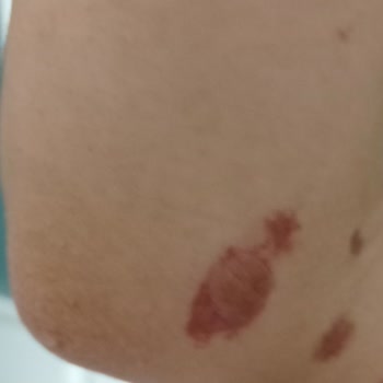 Mine Soydaş Beauty Lazer Kızımın Kollarını Yaktı