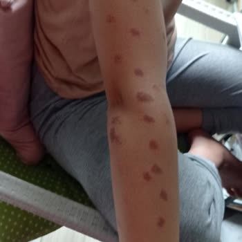 Mine Soydaş Beauty Lazer Kızımın Kollarını Yaktı