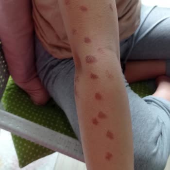 Mine Soydaş Beauty Lazer Kızımın Kollarını Yaktı