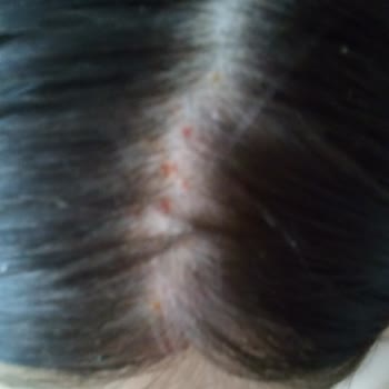 Gliss İntense Therapy Şampuan Aşırı Kaşıntı Yaptı