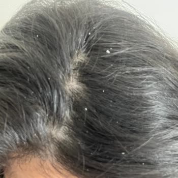 Ducray Anaphase Dökülme Karşıtı Şampuan Saçımı Mahvetti!