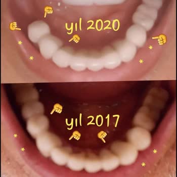Dentaltermin, Dentanorm, Alanya Dental Clinic, sie verkauften mir meine eigenen Zähne zurück