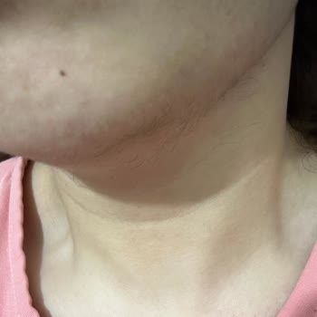 Hk1 Güzellik Salonu Lazer Sonrası Yüzüm Sakal Oldu!