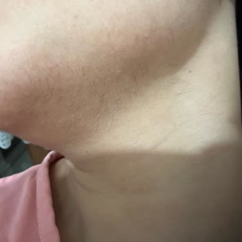 Hk1 Güzellik Salonu Lazer Sonrası Yüzüm Sakal Oldu!