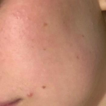 Kozvit.com Ürün Orijinal Değil Yüzümde Yanma Kızarma Yapıyor La Roche Baume B5