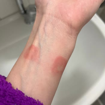 Apple Watch Alerji Yaptı