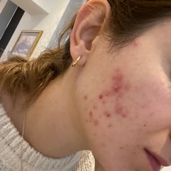 The Purest Solutions Sivilce The Purest