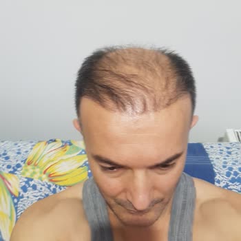 İsveç Klinik'te Saç Ekimi Mağduriyeti