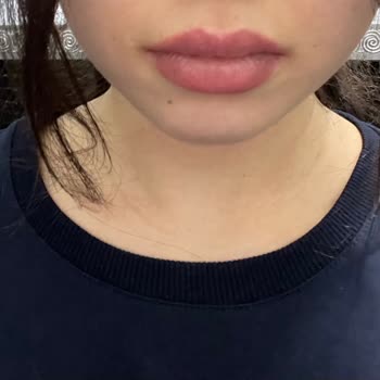 Bellaclinic&nbsp;Dudak Dolgusu Etkisiz