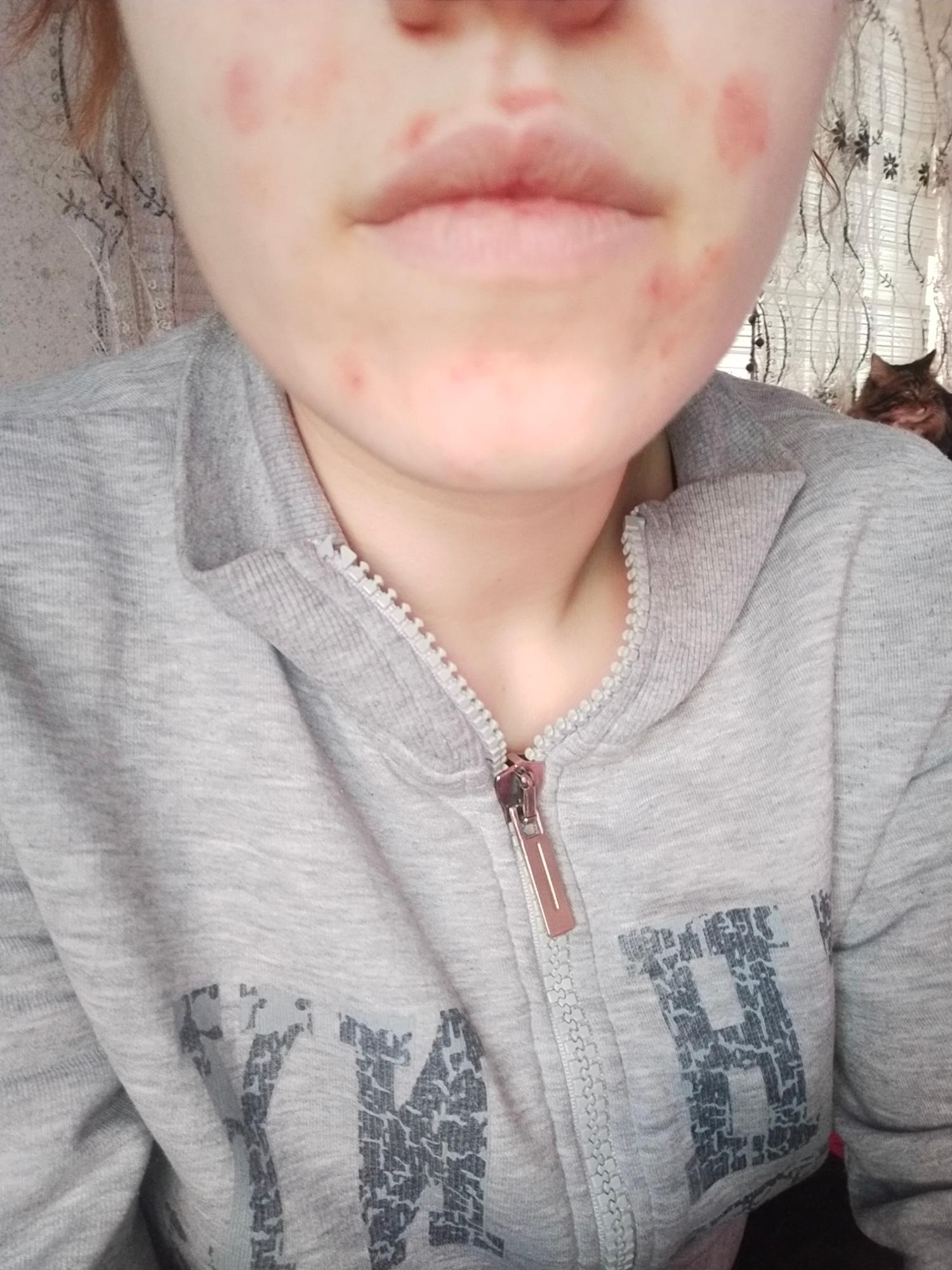 La Roche Posay Effaclar Burned My Face Xolvie