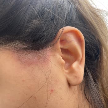 Nc Beauty Center Sıfır İlgi Alaka , Lazer Yanığı