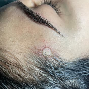 Nc Beauty Center Sıfır İlgi Alaka , Lazer Yanığı