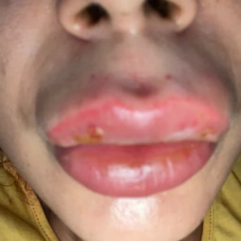 Africano Art Studio Dudak Dolgusu Yanlış İşlem Kalıcı Hasar