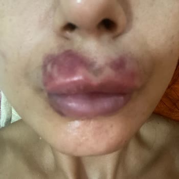 Africano Art Studio Dudak Dolgusu Yanlış İşlem Kalıcı Hasar