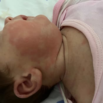 Bebelac Mama Alerji Yaptı