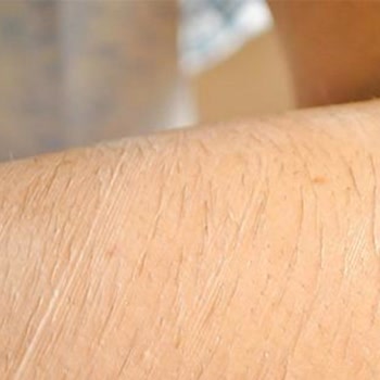 Jasmine Day Güzellik Merkezi Lazer Epilasyon Sorunu