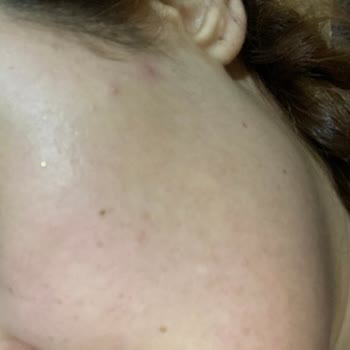 Loreal Paris Koyu Leke Karşıtı Krem Yüzümü Mahvetti