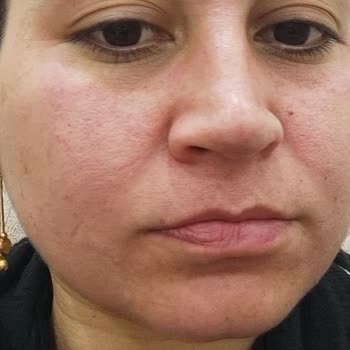 Nivea Aqua Rose Yüz Yıkama Köpüğü Kızarttı