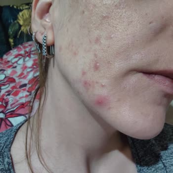 Solante Yüzümü Ve Psikolojimi Mahvetti