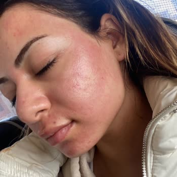 Novar Poliklinik Dudak Dolgusu Baby Face