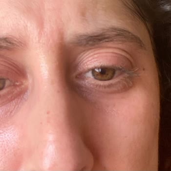 Loreal Paris Yüzüm Yandı Ve Kaşınıyor