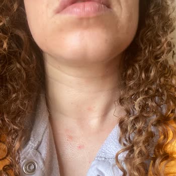 Loreal Paris Yüzüm Yandı Ve Kaşınıyor