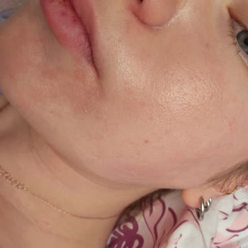 Seda Altın (BSA Grup Danışmanlık) Altın Kil Maskesi Yanma ve Kızarıklık Yaptı