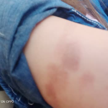 Mezo-es Güzellik&nbsp; Buz Lazer Epilasyonda Jelsiz İşlem Yapılması Sonucu Oluşan Yanıklar