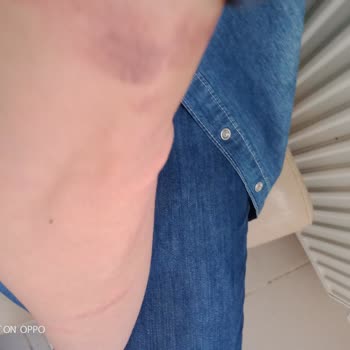 Mezo-es Güzellik&nbsp; Buz Lazer Epilasyonda Jelsiz İşlem Yapılması Sonucu Oluşan Yanıklar