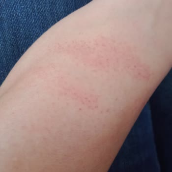 Mezo-es Güzellik&nbsp; Buz Lazer Epilasyonda Jelsiz İşlem Yapılması Sonucu Oluşan Yanıklar