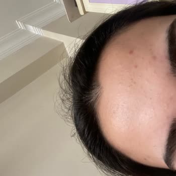 Bioderma Sivilce Ve Komedon Sorununa Sebep Oldu