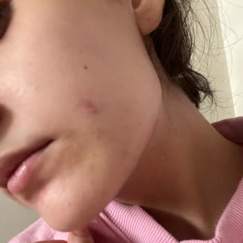 Bioderma Sivilce Ve Komedon Sorununa Sebep Oldu