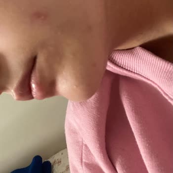 Bioderma Sivilce Ve Komedon Sorununa Sebep Oldu