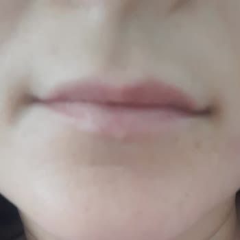 Özden Aksoy Güzellik Merkezi'nde Dudak Vitamini İşlemi