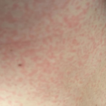 Abdi İbrahim Factive Antibiyotik Yan Etki