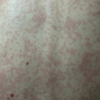 Abdi İbrahim Factive Antibiyotik Yan Etki